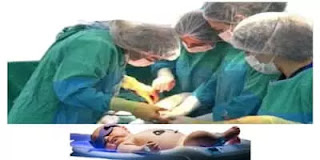 cesarean section