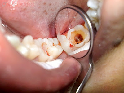 Nguyên nhân gây sâu răng