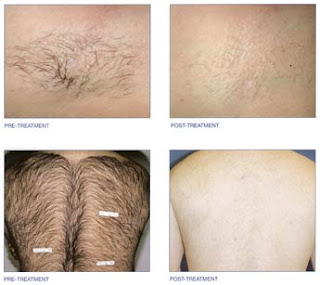 permanent hair removal picture or photo