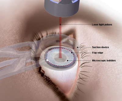 laser eye surgery 0
 on Inventions: Laser eye surgery
