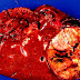 Hepatocellular carcinoma