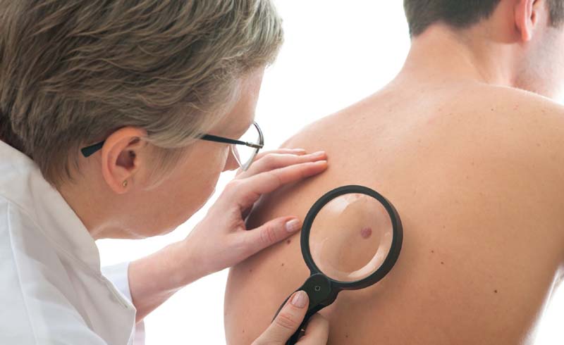 Signs of Skin Cancer