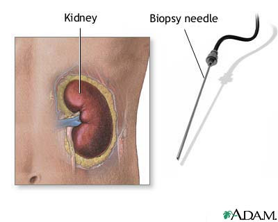 biopsy 
