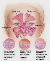 penyakit sinusitis