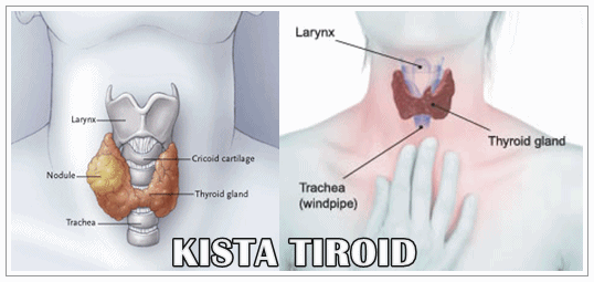 Cara Mengobati Kista Tiroid