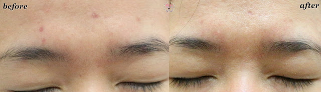 before-after suplemen H2 Pure Skin