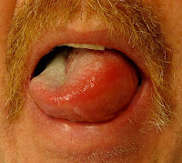  Image of tongue affected by angioedema