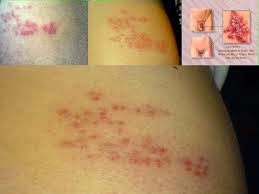 Obat Infeksi Virus Herpes