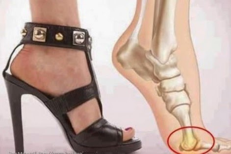 DAÑOS QUE OCASIONA EL USO DEL ZAPATO INADECUADO