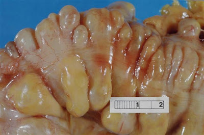 Diverticulitis