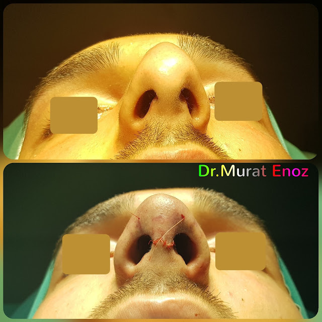 Male Nose Aesthetic Surgery in Turkey, Men's Rhinoplasty in Istanbul,Nose Job in Male Patient, Rhinoplasty in Men Istanbul,