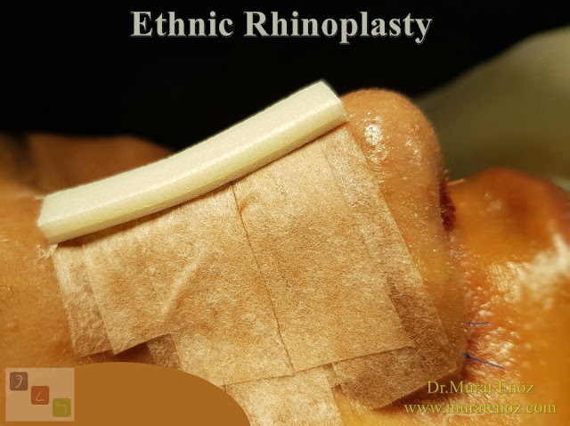 Ethnic Rhinoplasty Istanbul - Dr.Murat Enoz - Nose job in Istanbul - Nose surgery in Istanbul - Nose job in Turkey - Ethnic rhinoplasty Turkey - Ethnic rhinoplasty in Turkey - African American rhinoplasty - Ethnic expert nose job surgeon - Rhinoplasty surgeon in Istanbul - Black nose job - Rhinoplasty for ethnic nose - Rhinoplasty for African people - African American nose surgery - Rhinoplasty for African American Nose - Thick skin rhinoplasty - Rhinoplasty in istanbul