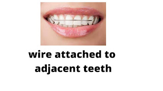 wire attached to adjacent teeth