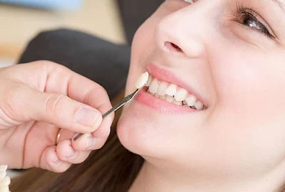 Có nên bọc răng sứ cho răng khểnh không?