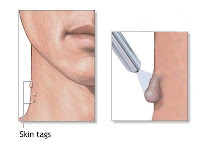 Certain Home Remedies For Skin Tag Removal