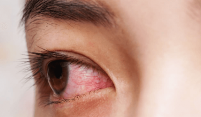 How to Easily Overcome the Luffy Eyes and Runny