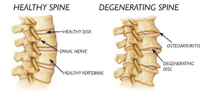 Degenerative Disc Disease Pictures