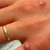 Infectados com a varíola do macaco podem transmitir doença por quatro semanas, diz especialista