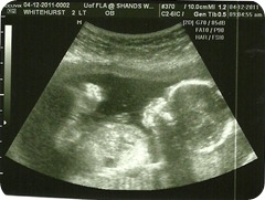 Baby 2 Profile @ 17 weeks Baby 2 Profile @ 17 weeks