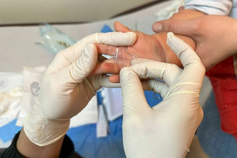Desde el Hospital Osorno hacen llamado a la prevención de quemaduras domésticas en niños