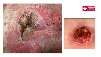 What Are Bedsores (Pressure Ulcers)?