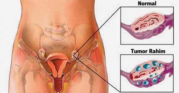 Stop Sekarang Juga Sebelum Menyesal! Tanpa Disadari “Kebiasaan Ini” Bisa Bikin Rahim Kamu Harus Diangkat Bahkan Dapat Menyebabkan Tumor Loh