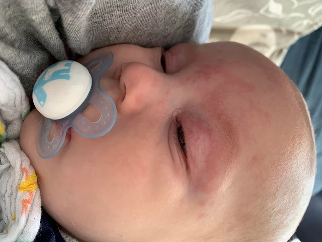 Close up of baby boy with a dummy in and blotchy from crying from feeling poorly after 12 week immunisations