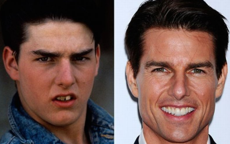 Tom Cruise dental treatment before and after