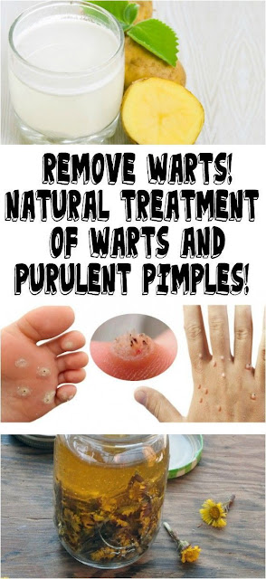 REMOVE WARTS! NATURAL TREATMENT OF WARTS AND PURULENT PIMPLES!