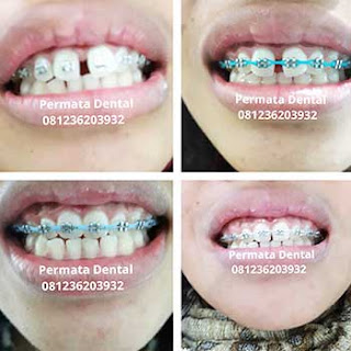 gambar foto behel bracket kawat gigi sebelum dan sesudah perawatan untuk memperbaiki merapikan gigi gingsul gigi miring renggang tonggos berantakan keluar masuk jarang diastema maju mundur tidak rapi tidak beraturan bali denpasar banyuwangi jember tidak rata kocar kacir