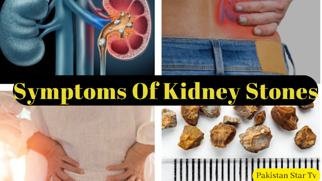 What Are the Common Kidney Stones Symptoms