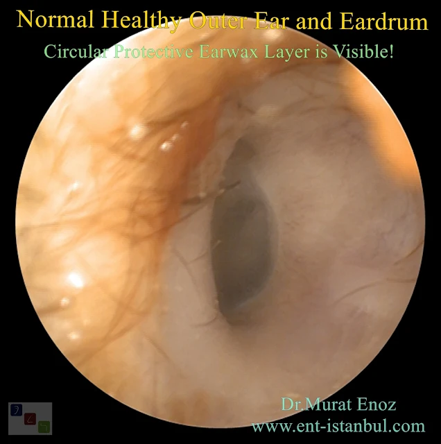Normal Healthy Outer Ear and Eardrum