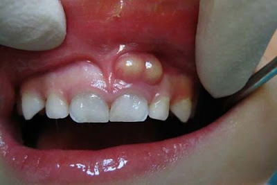 Áp xe chân răng có nguy hiểm không? 