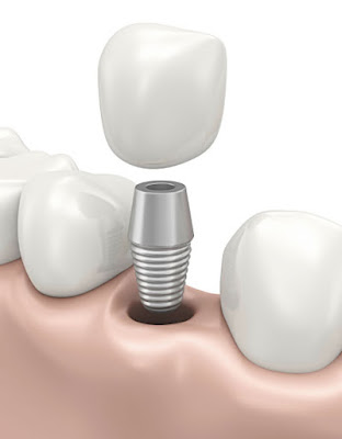 Dental implant treatment Long Island
