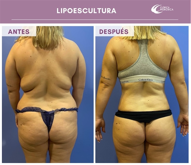 Lipoescultura circunferencial nueva cirugía corporal