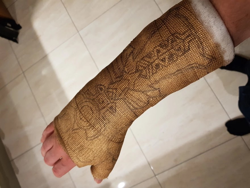 After This Guy Broke His Wrist, He Decided To Transform His Cast Into The Infinity Gauntlet Of Thanos