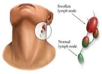 Cara Ampuh Mengobati Penyakit Kelenjar Getah Bening