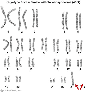 karyotype male. karyotype male. the karyotype