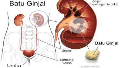 Cara Menyembuhkan Penyakit Batu Ginjal