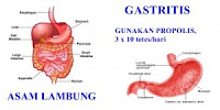 obat penyakit asam lambung