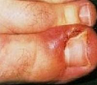 ingrown toenail