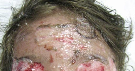 TheCLINIC: Antibiotik punca penyakit ngeri Steven Johnson 