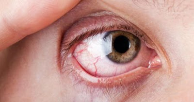 CIK ILA MENARI: Petua nak hilangkan sakit mata tanpa ubat.