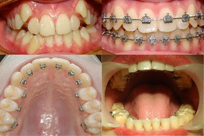 Niềng răng khểnh thẩm mỹ là gì?