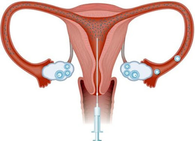 Dibujo de inseminación artificial a una mujer a colores