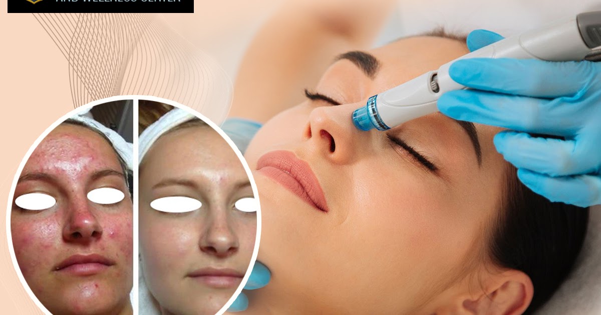  Things to Follow before Undergoing a Hydrafacials Therapy