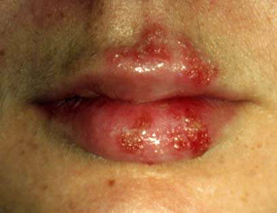 Topical Relief For Genital Herpes : Getting Rid Of Cold Sores - What Will Give You Rapidly Cold Sore Relief_