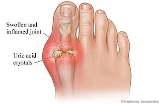 Cara mengobati asam urat di pergelangan kaki, obat medis untuk penyakit asam urat, jus buah penurun asam urat dan kolesterol, ubat asam urat herbal, asam urat gout ppt, cara mengatasi asam urat dan pantangannya, obat generik untuk asam urat dan rematik, cara mengobati asam urat dengan minyak zaitun, asam urat batu ginjal, mengatasi asam urat saat kambuh, obat asam urat dan pantangan makan