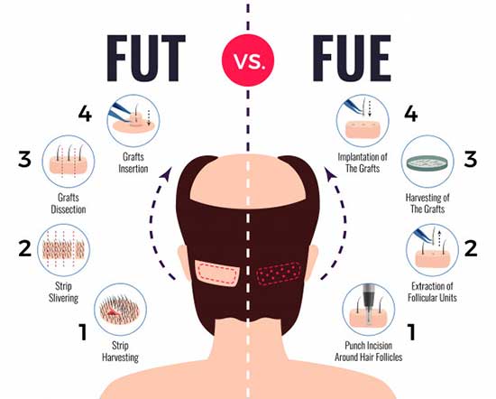 fut-vs-fue Types of Hair Transplant Surgery method