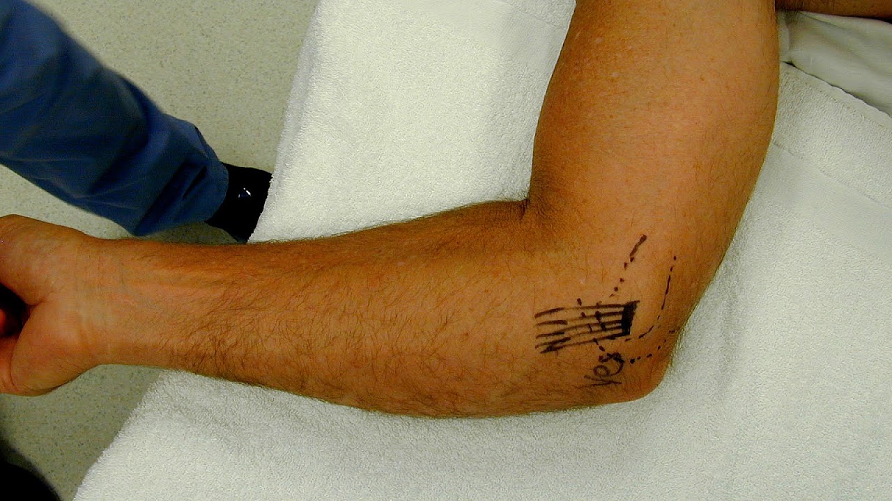 Ulnar collateral ligament injury of the elbow